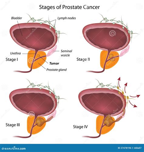 Stages of prostate cancer stock vector. Illustration of human   27478196
