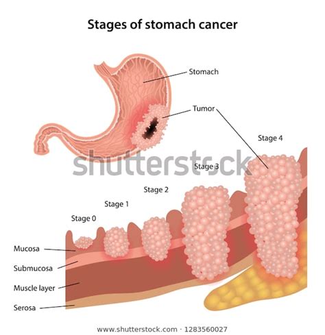 Stages Stomach Cancer Growth Cancer Tumor Stock Vector ...