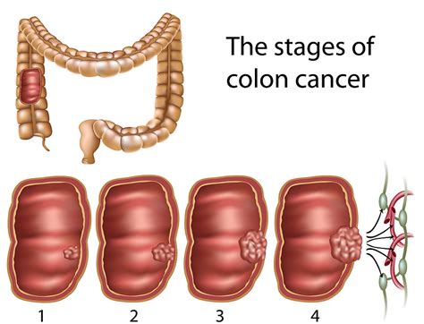 Staging Colon Cancer   Colorectal Surgeons Florida