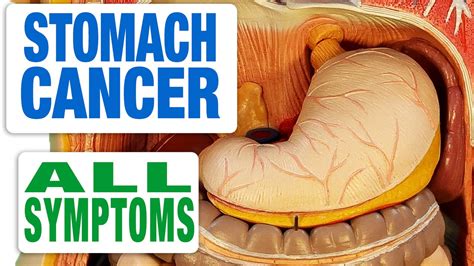 Stomach Cancer   All Symptoms   YouTube