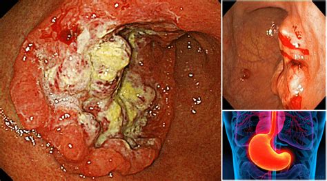 Stomach Cancer Causes Symptoms and Prevention ...