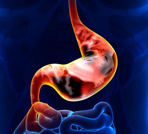 Stomach Cancer: Causes, Symptoms, and Treatments   Medical ...