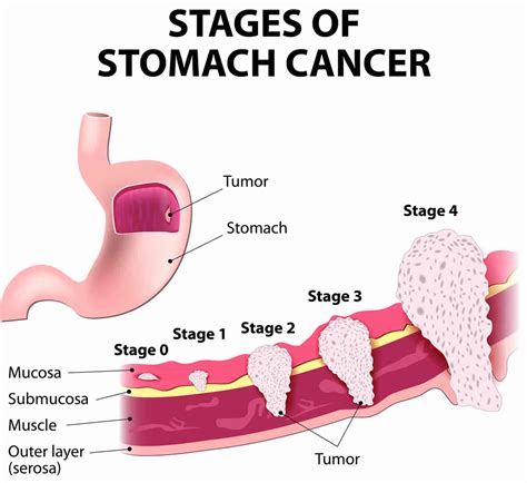 Stomach Cancer   Causes, Symptoms, Diagnosis and Treatment