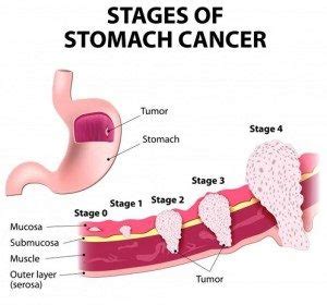 Stomach Cancer  Gastric Adenocarcinoma  Symptoms, Causes ...