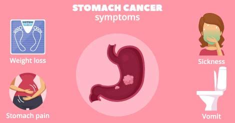 Stomach Cancer Signs of Early Stages