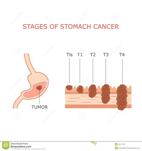 Stomach cancer stages, stock vector. Illustration of ...