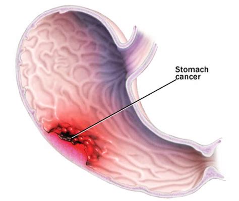 Stomach cancer   Symptoms, causes and other risk factors