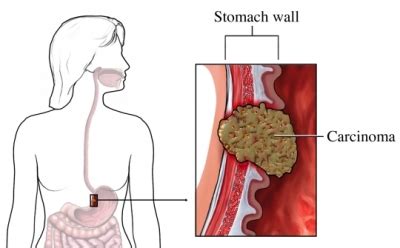 Stomach Cancer | UVA Health