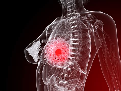Stress Hormone Therapy Used To Treat Breast Cancer Side ...