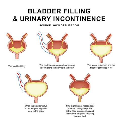 Stress Urinary Incontinence in Females