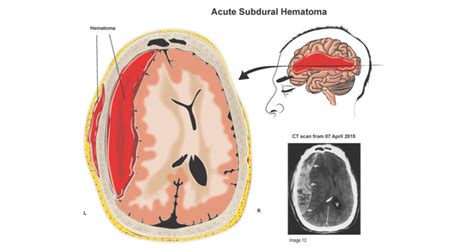 Subdural hematoma after a car accident