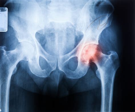 Super cap spares tissue in hip replacement surgery