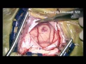 Surgical footage of removal of Glioblastoma Multiforme ...