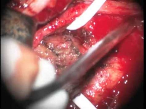Surgical Management of Glomus Carotid Tumor   YouTube