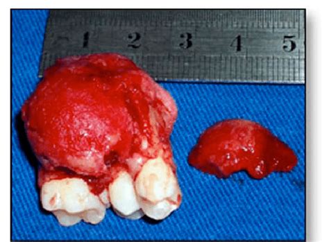 Surgical specimen of the tumor and associated teeth. The second molar ...
