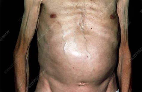 Swollen abdomen due to spreading skin cancer   Stock Image ...