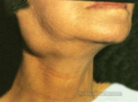 Swollen Glands in Neck   Causes, Treatment, Pictures