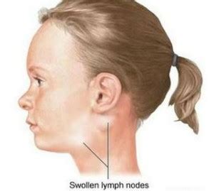 Swollen Glands in Neck   Symptoms, Causes, Treatment