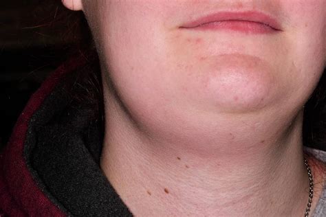 Swollen Lymph Glands In Neck Photograph by Dr P. Marazzi ...