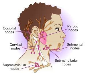 Swollen Lymph Nodes in the Neck   Dr Paulose