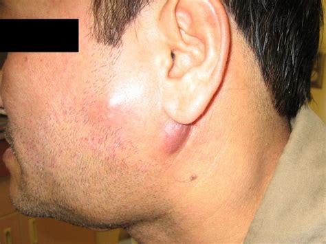 Swollen lymph nodes   symptoms, causes and complications