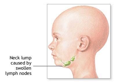 Swollen Lymph Nodes   Symptoms, Causes, In Neck, In Groin ...