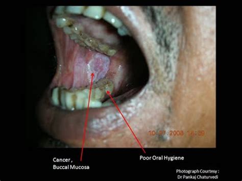 Symptoms & Early Signs of Oral Cancer   Arecapedia