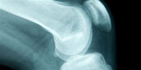 Symptoms of bone cancer | Bone cancer signs | Cancer