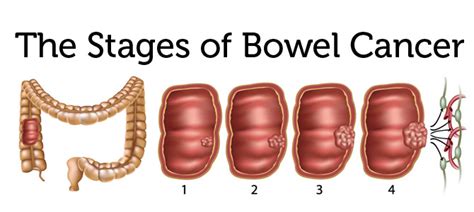 Symptoms of bowel cancer | Daily Family NG