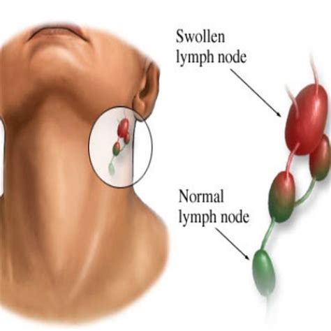 Symptoms Of Cancer In The Lymph Nodes | Lady Care Health