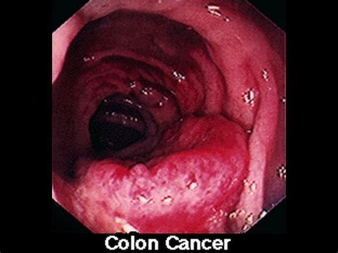 Symptoms of Colon Colorectal Cancer in Men & Women   YouTube