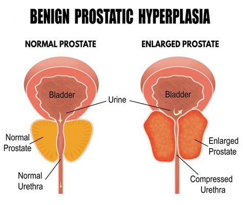 Symptoms Of Infected Prostate Gland   ProstateProHelp.com