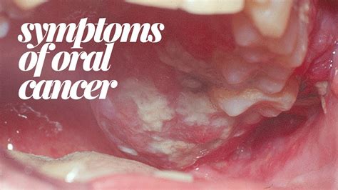 SYMPTOMS OF ORAL CANCER   YouTube