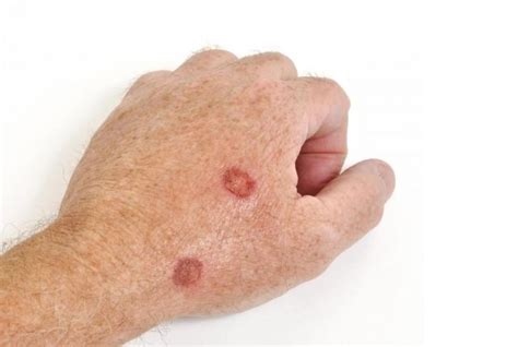 Symptoms Of Skin Cancer On Hands   Cancer News Update