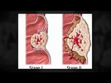 Symptoms of Stomach Cancer   YouTube