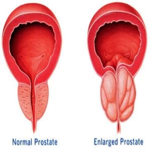 Symptoms & Types of Prostate Enlargement | St Pete Urology ...