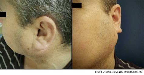 Synchronous multiple unilateral parotid gland tumors of benign and ...