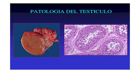 T5 Patología testicular   [PDF Document]