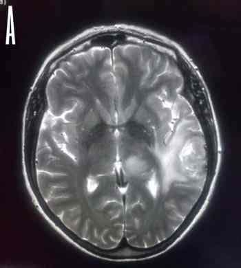 TAC craneal glioblastoma