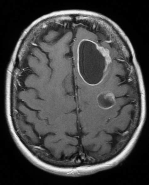 Tapas de Ciencia: METÁSTASIS CEREBRAL