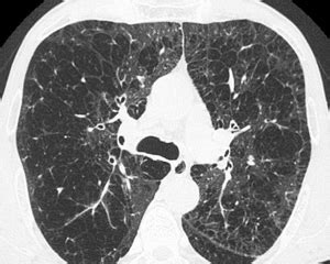 TC muestra cambios en pulmones asociados con EPOC ...