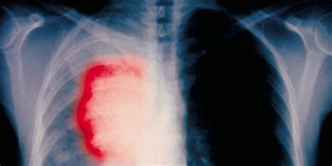 Terapia alternativa del cáncer de pulmón busca eliminar la ...