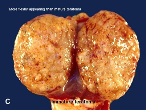 Teratoma / A An Extragonadal Mature Cystic Teratoma And B A Right ...