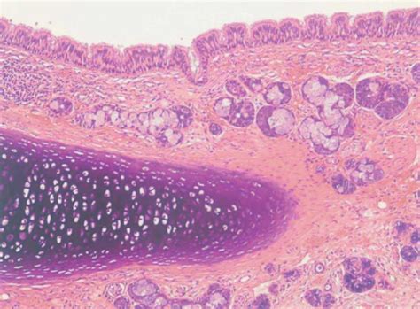 Teratoma bilateral de ovario | Anales de Pediatría