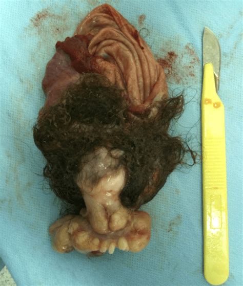 Teratoma de ovário: dos sintomas ao tratamento   Dr. Fernando Guastella