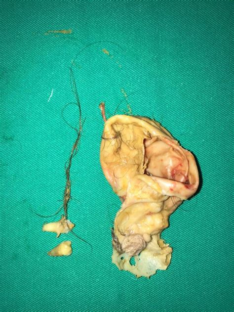 Teratoma de ovário   Forum do Atlas Cirúrgico