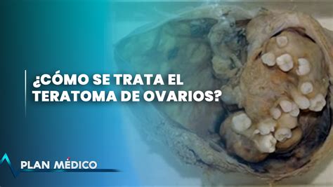 Teratoma de ovarios | Plan Médico  2/2    Cachicha.com