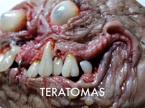Teratoma En Ovario   SEONegativo.com