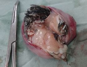 Teratoma gigante de ovario derecho en paciente pediátrico | Cáceres ...