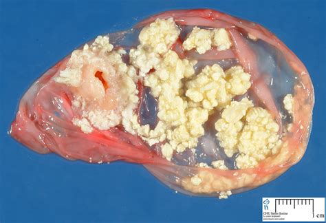 teratoma   Humpath.com   Human pathology